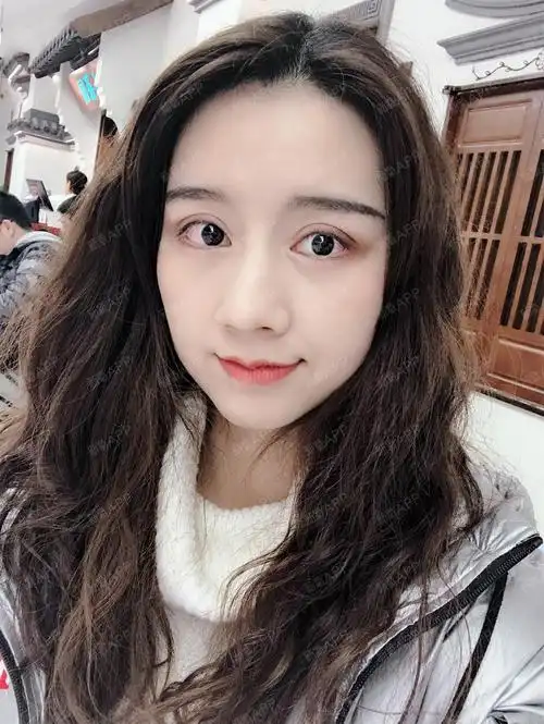 南京双眼皮全切平行,这个眼又大又圆!