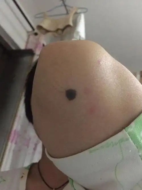 两个胳膊都有痣有一个大的超过6mm长了十几年不痛不痒