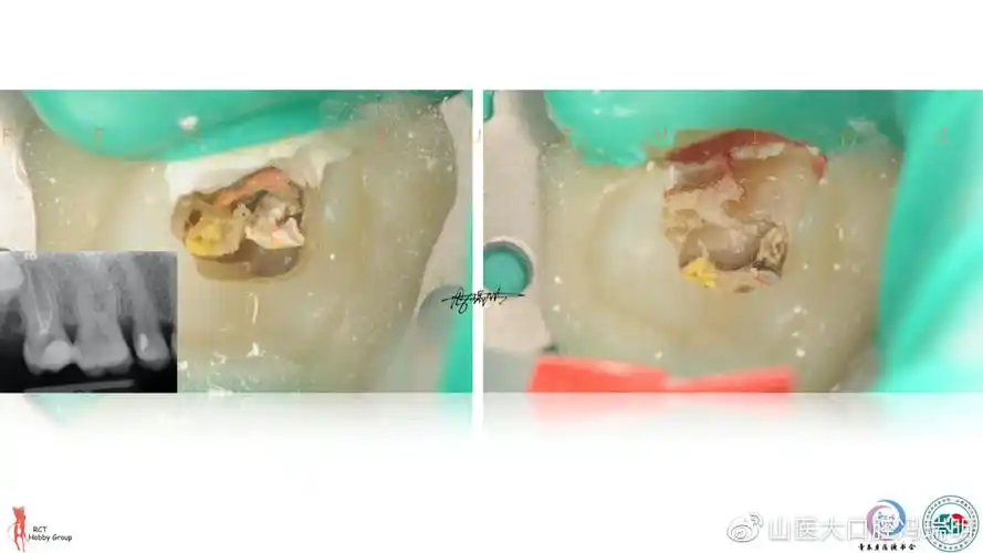 上颌第二磨牙根管解剖形态特点及病例分享