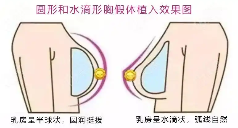 瘦人平胸做隆胸选圆形还是水滴形状好看选150200220cc多大合适
