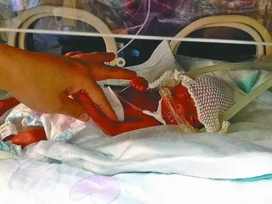 女子怀孕6个多月突早产 男婴仅900克只有巴掌大(2)