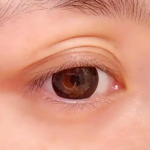 多层眼皮为什么会出现三眼皮呢?