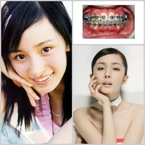 杨幂牙齿矫正前后对比