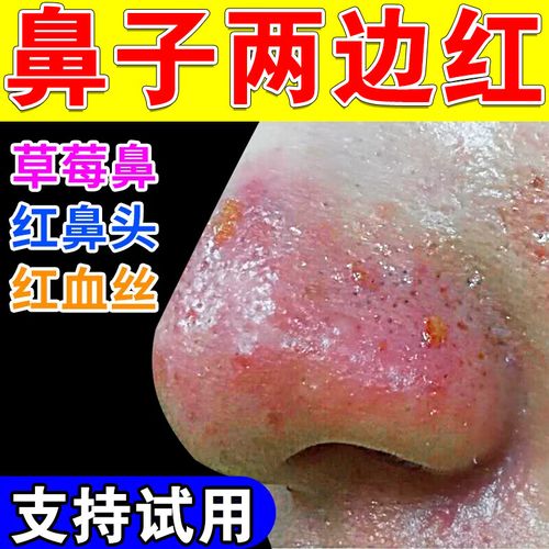 酒糟鼻专用修复i药红鼻子草莓鼻去黑头粉刺收缩毛孔抑i菌软膏 单盒装