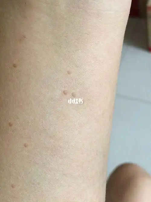 最后终于好了!心酸史!_眼药水_猪油_扁平疣_医疗健康_医疗药品