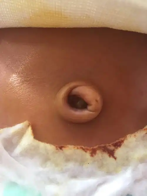 肚脐眼_肚脐炎和肚脐湿疹区别_虐肚脐文章钻肚脐吧