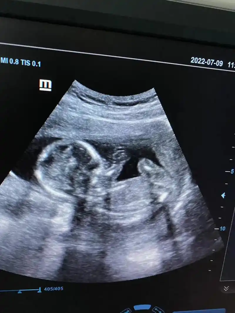 四维彩超 #产检一路绿灯 #虎宝宝 你们的四维照片是这样的 - 抖音