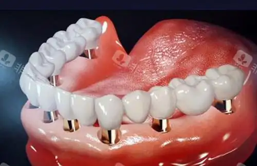 上海全口种植牙收费价目表,鼎植/雅悦/钛植口腔种牙不贵!-非常爱美