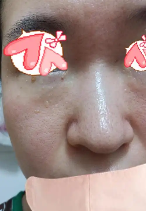 问问我这张脸毛孔很大是不是角质薄?求点建议