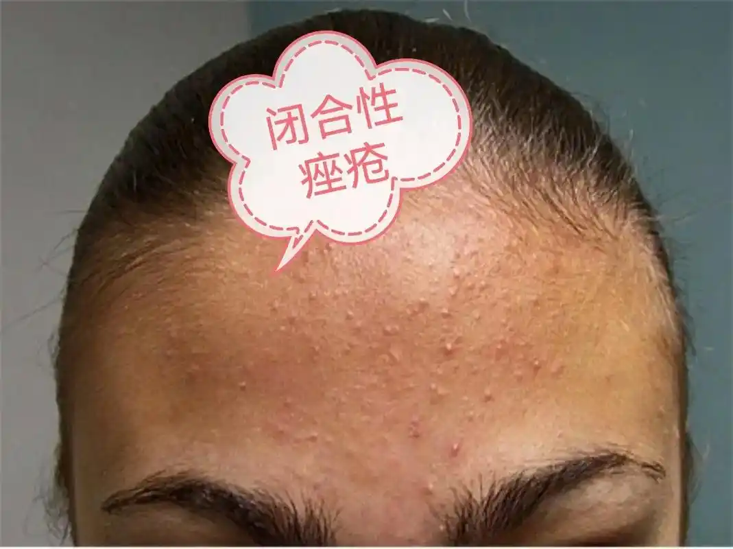 告别肌肤问题 #解决任何皮肤问题 # - 抖音