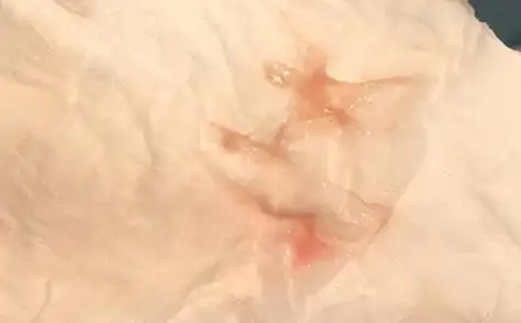 着床出血图片1受精卵着床出血是因为在妊娠初期的时候受精卵在子宫