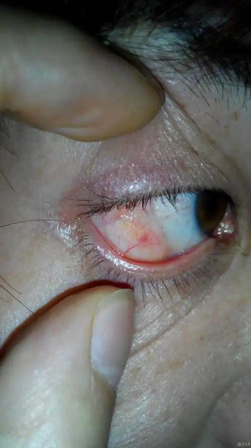 我昨天刚刚收集的双眼结膜脂肪瘤