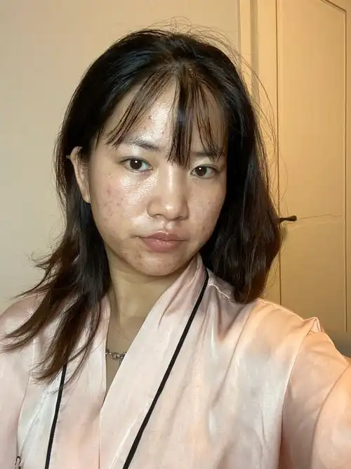 大油皮痘痘肌毛孔粗大为什么都在我脸