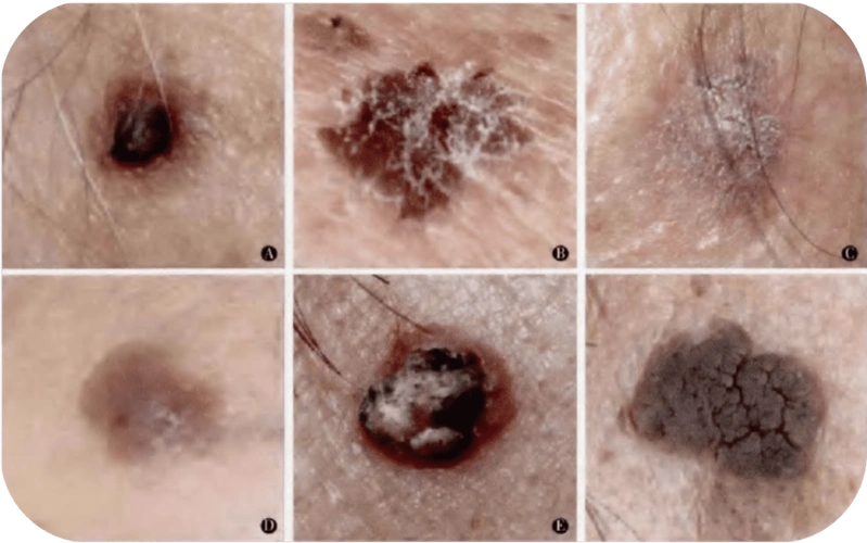 1个月发现6例这些皮肤癌经常伪装成老年斑早自查早就医