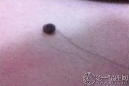 痣上长毛好不好 痣上有毛面相如何