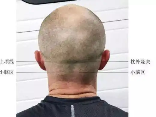 常见的小脑刺激位点体表定位为枕骨粗隆左/右旁开3cm或枕骨粗隆左/右