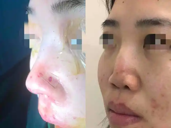 binder综合征是颅颌面外科的常见疾病,其发病机理目前还不是十分清楚.