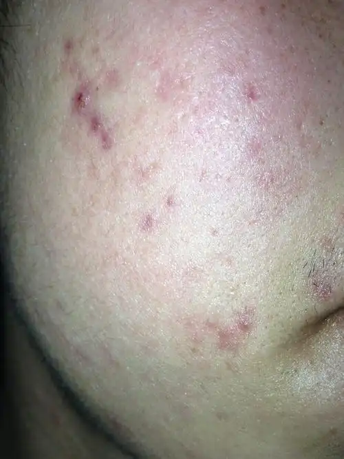 求助请问这个是毛囊炎吗有图有病历