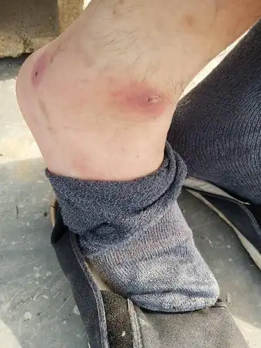 我在非洲尼日利亚拉各斯,不知是不是被虫子咬了,脚裸上起了两个嘎达