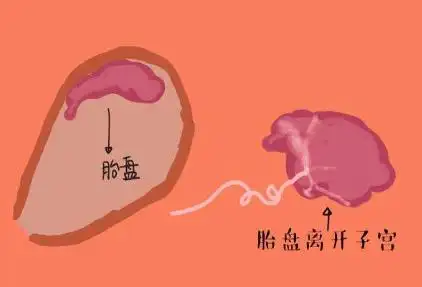 哪些孕妇容易遭遇手剥胎盘?_子宫