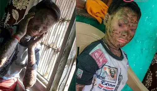 社会热点 > 人蛇女孩每6周蜕皮    据悉,这个印度的人蛇小女孩今年才