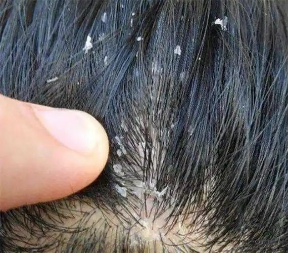 头皮油能抠下灰泥说明几万螨虫扎根毛孔再不除螨会越扎越深