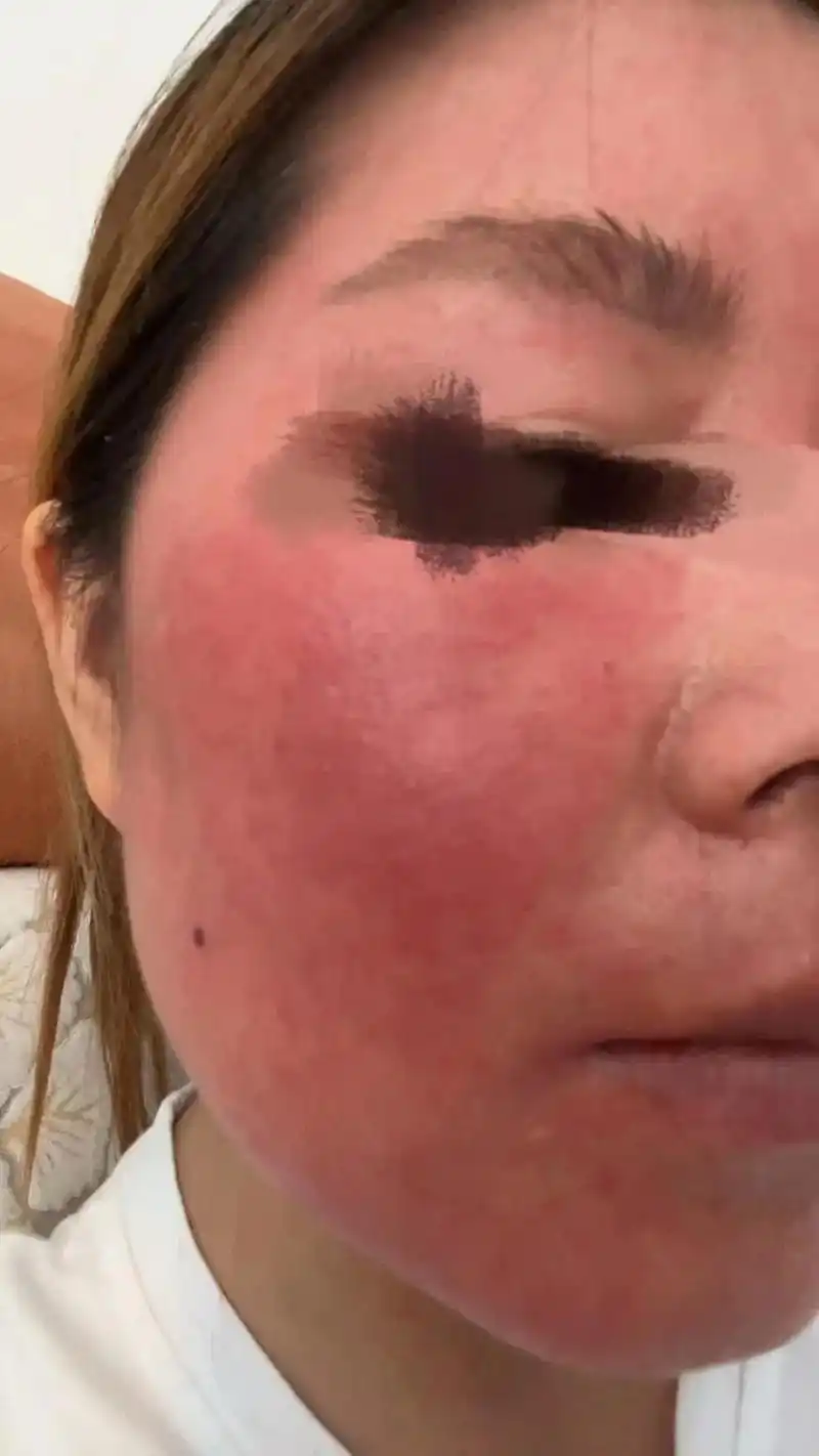 皮肤一受刺激一冷一热就发红发烫,空调房 - 抖音