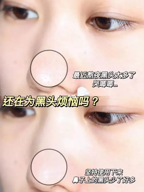 刷酸_黑头_水杨酸_闭合性粉刺_去黑头_芙清怎么样_清洁_温和刷酸妹