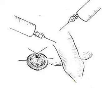 图解包皮手术全过程