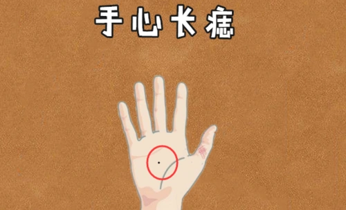 手心长痣