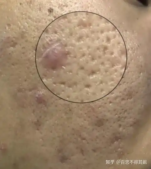 图片慎点这属于器质性毛孔粗大吗护肤品还有救不哭