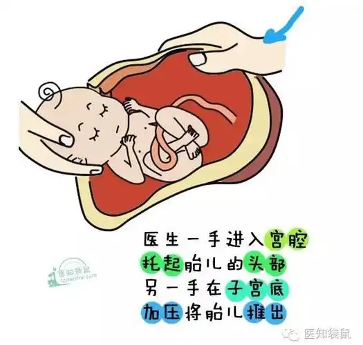 揭秘:剖宫产手术全过程