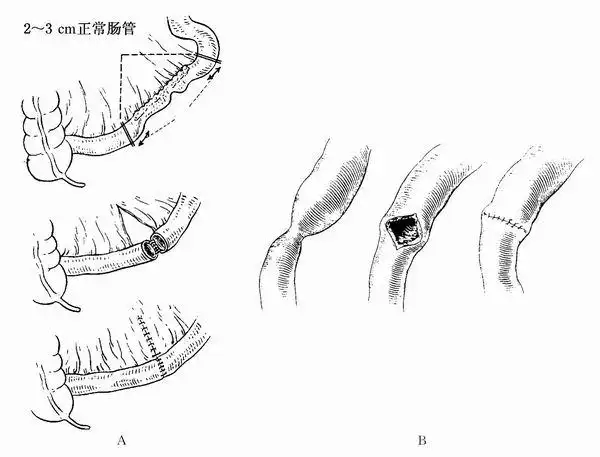 外科疗法及适应证