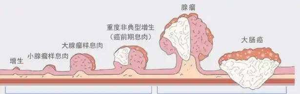 结节,息肉,囊肿,增生等,哪个才是癌症的先兆?_癌变_复查_治疗