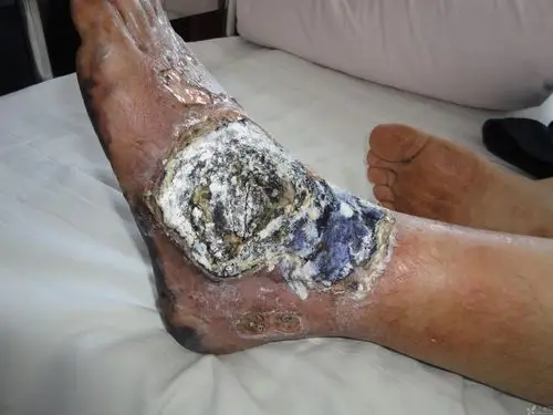 足部皮肤坏死,植皮还是皮瓣修复好?