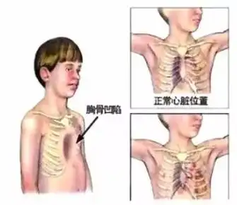 "鸡胸"形成原因有许多,及时治疗与改善为关键_畸形