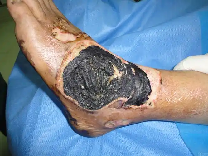 足部皮肤坏死,植皮还是皮瓣修复好?