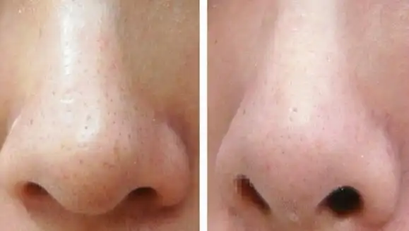 收缩毛孔去黑头的方法