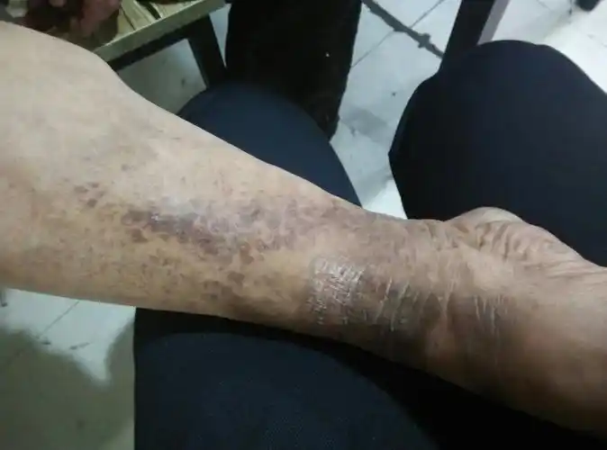 我爸爸腿起了这些斑点,这是什么病?这有了很多年头了.