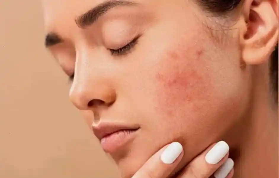 肌肤 节后肌肤问题频发?你只需要一支水光