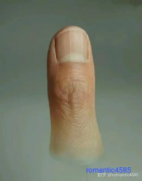 第九章:  大拇指缺节患者注意事项