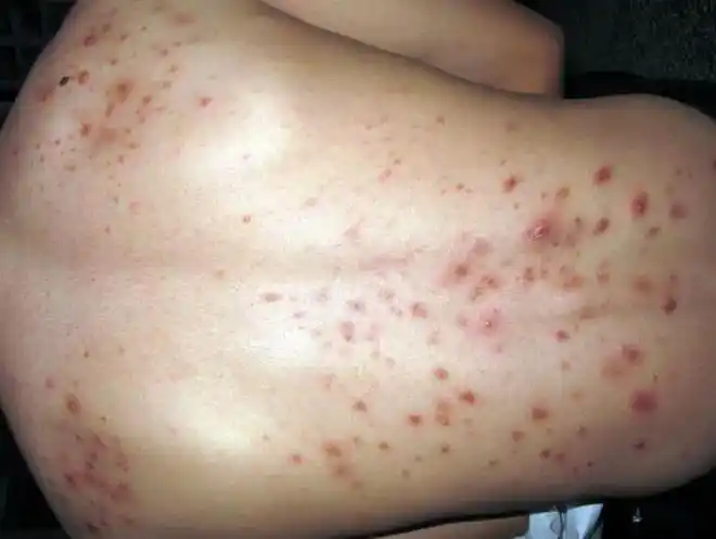 背上长痤疮?可能是马拉色菌感染毛囊炎,治疗需要注意!