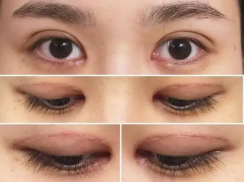 超级详细高清图 全切双眼皮 开眼角