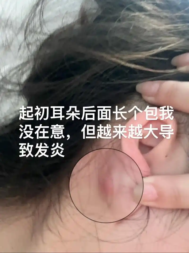 小小皮下囊肿拿下!#脆皮大学生来了 - 抖音