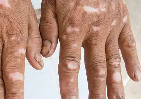 白斑病是什么样子的(附图片)