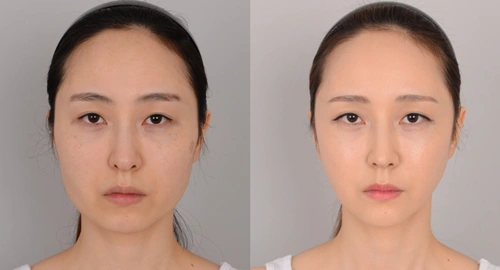 韩国jj洪镇柱整形外科面部轮廓综合整形对比