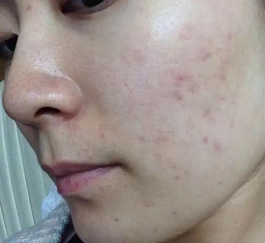 女生脸上毛孔粗大油光满面别慌5招还你清爽细嫩宝宝肌