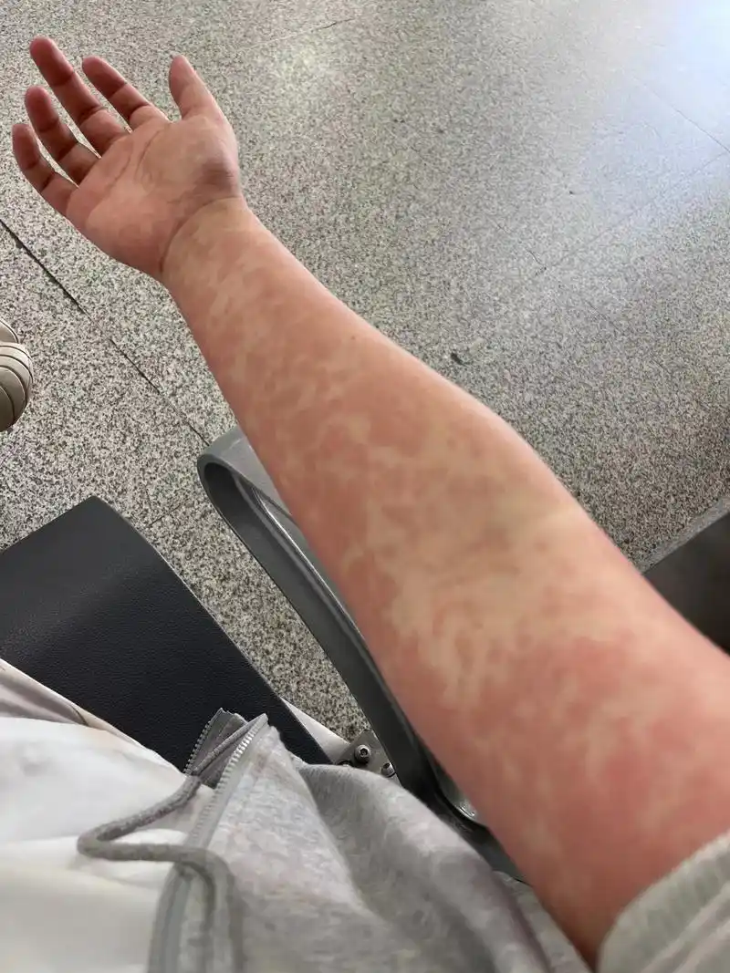 洗了个澡后中毒性红斑咯.#大学生脆弱故事会#皮肤 #遇到凡事 - 抖音