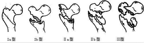 影像医学和核医学讨论版 骨肌         jensen等在evans分型的基础上