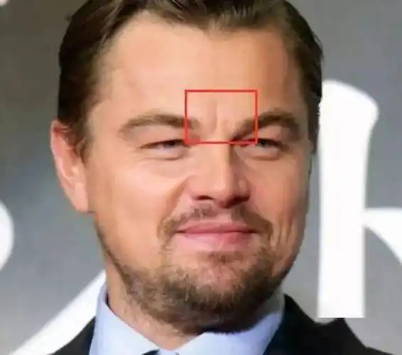 这两块肌肉长期紧张,会导致眉心出现川字皱纹,山根出现横纹